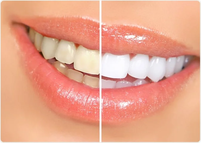 How Veneers Address Tooth Discolouration That Whitening Cannot Fix